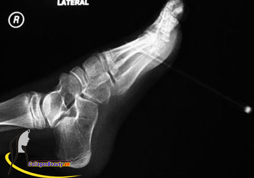 Chụp X-quang để kiểm tra chấn thương ở vùng cổ chân là điều cần thiết để tránh những trường hợp đáng tiếc xảy ra