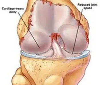 Bệnh đau khớp, cách phòng và chữa trị bệnh đau khớp