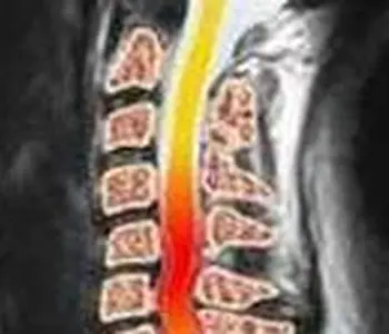 Bệnh đau vai gáy và cách đối phó