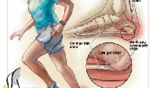 Những tổn thương do chạy bộ có thể dẫn đến bệnh viêm xương khớp