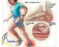 Những tổn thương do chạy bộ có thể dẫn đến bệnh viêm xương khớp